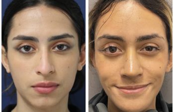 Woman before and after rhinoplasty