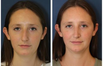 Woman before and after rhinoplasty