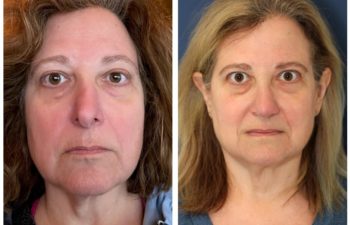 Woman before and after revision rhinoplasty