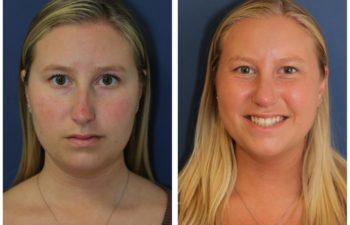 Woman before and after rhinoplasty