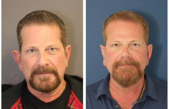 Man before and after rhinoplasty