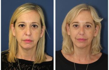 Woman before and after revision rhinoplasty