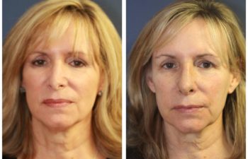 Woman before and after revision rhinoplasty