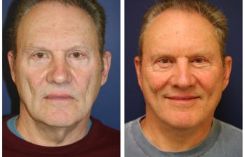 Man before and after facelift