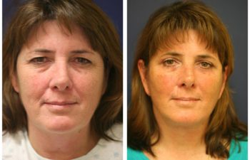 Woman before and after facelift