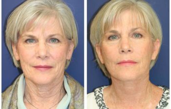 Woman before and after facelift