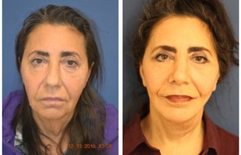 Woman before and after facelift