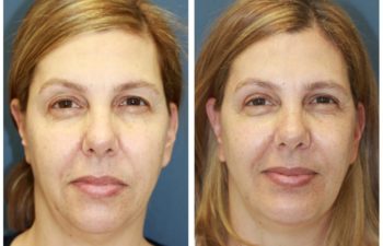 Woman before and after facelift