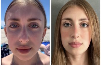 Woman before and after rhinoplasty