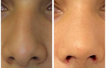 Man before and after rhinoplasty