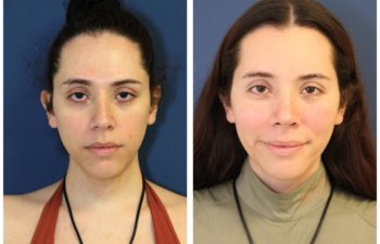 Woman before and after facial feminization