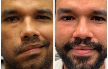 Patient before and after nerve transfer and selective neurolysis