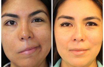 Patient before and after nerve grafting and repair