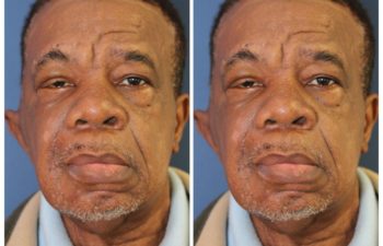Patient before and after temporalis muscle transfer