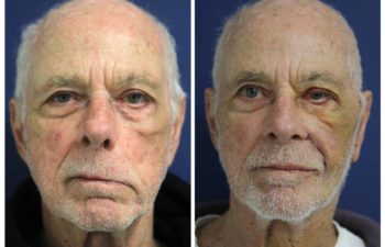 Patient before and after tensor fascia lata sling