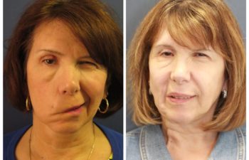 Patient before and after gracilis muscle transfer