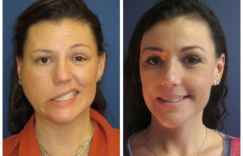 Patient before and after nerve grafting and reconstruction