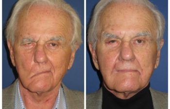 Patient before and after temporalis muscle transfer and brow lift