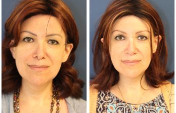 Woman before and after revision rhinoplasty