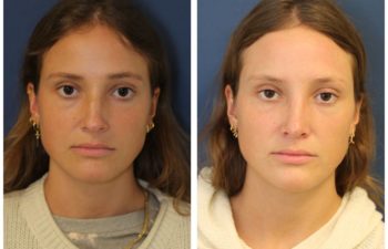 Woman before and after rhinoplasty