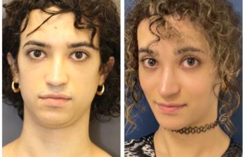 Patient before and after facial feminization