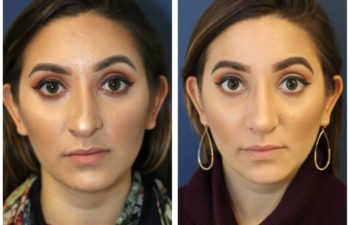 Woman before and after revision rhinoplasty