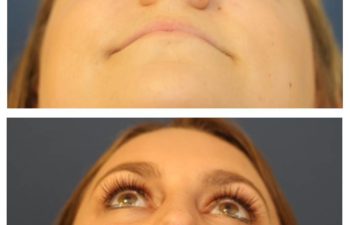 Woman before and after rhinoplasty