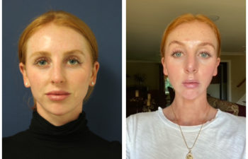 Woman before and after rhinoplasty