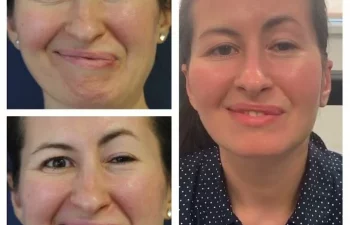 Facial Nerve Paralysis patient before and after treatment