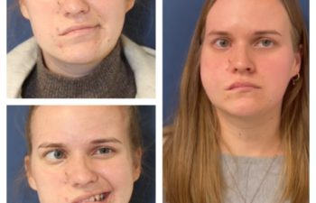 Facial Nerve Paralysis patient before and after treatment