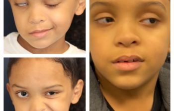 Facial Nerve Paralysis patient before and after treatment