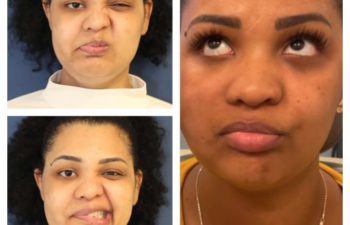 Facial Nerve Paralysis patient before and after treatment