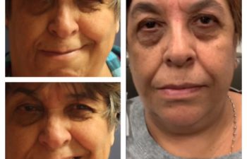 Facial Nerve Paralysis patient before and after treatment