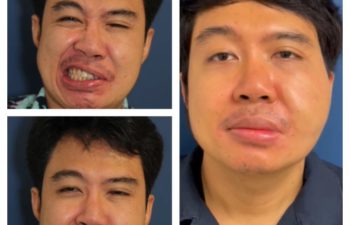 Facial Nerve Paralysis patient before and after treatment