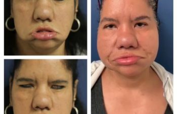 Facial Nerve Paralysis patient before and after treatment