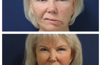 Facial Nerve Paralysis patient before and after treatment