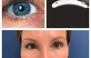 Facial Nerve Paralysis patient before and after treatment