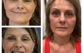 Facial Nerve Paralysis patient before and after treatment