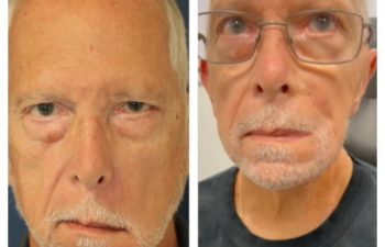 Facial Nerve Paralysis patient before and after treatment