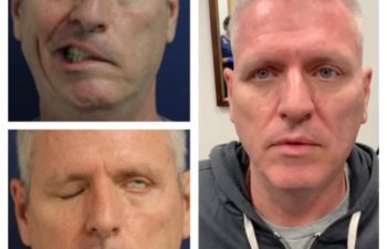 Facial Nerve Paralysis patient before and after treatment
