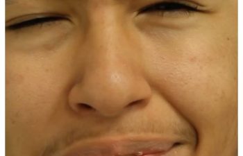 Facial Nerve Paralysis patient before and after treatment