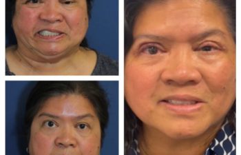 Facial Nerve Paralysis patient before and after treatment