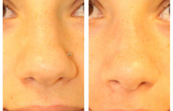 Girl before and after nose surgery