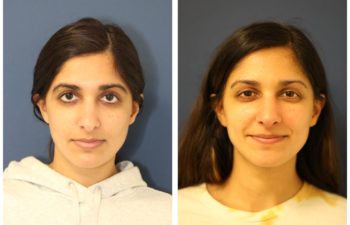 Girl before and after nose surgery