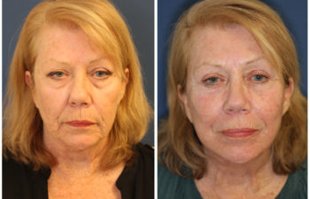 Woman before and after facelift