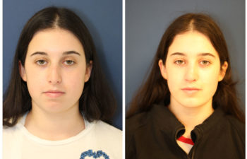 Girl before and after nose surgery