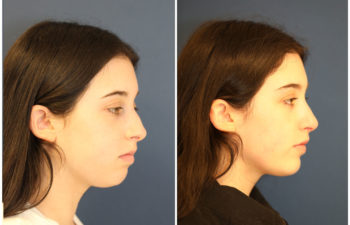 Girl before and after nose surgery