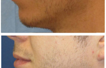 Male patient before and after facial implant surgery