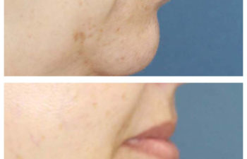 Female patient before and after facial implant surgery