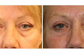Upper Eyelid Blepharoplasty